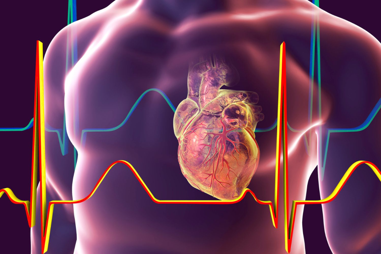 ECG NYMVC