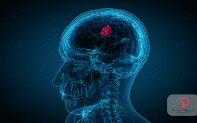 Recognizing the Early Signs of a Stroke