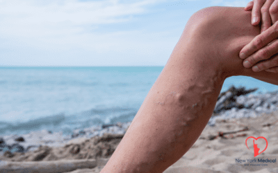 Varicose Veins: Modern Treatments and the Importance of Early Intervention